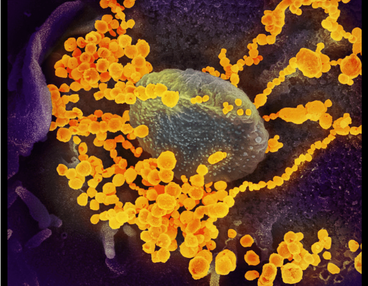 Dieses Bild zeigt SARS-CoV-2 (gelb), das von einem Patienten in den USA isoliert und mit dem Rasterelektronenmikroskop fotografiert wurde. Die blauen und rosa Flächen sind im Labor kultivierte Zellen. 