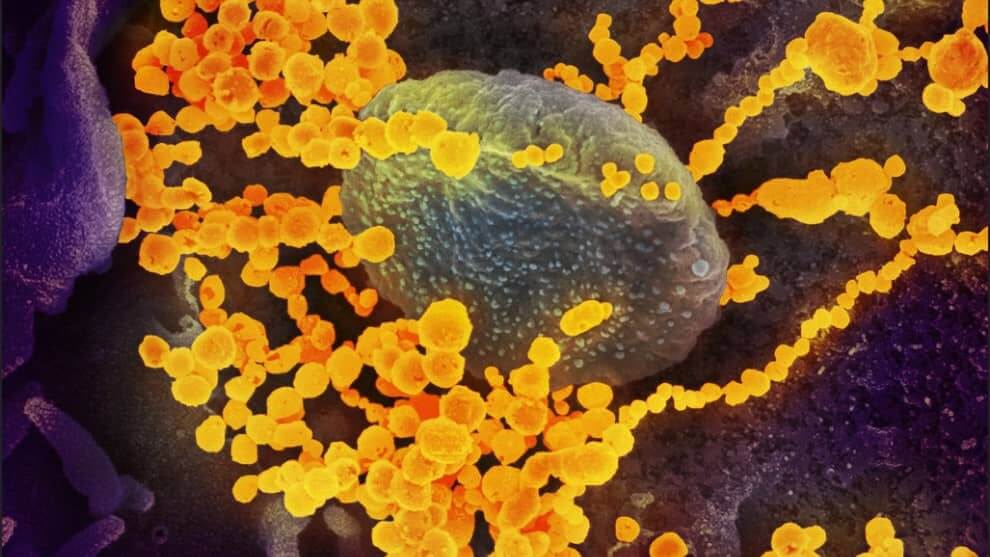 Dieses Bild zeigt SARS-CoV-2 (gelb), das von einem Patienten in den USA isoliert und mit dem Rasterelektronenmikroskop fotografiert wurde. Die blauen und rosa Flächen sind im Labor kultivierte Zellen.