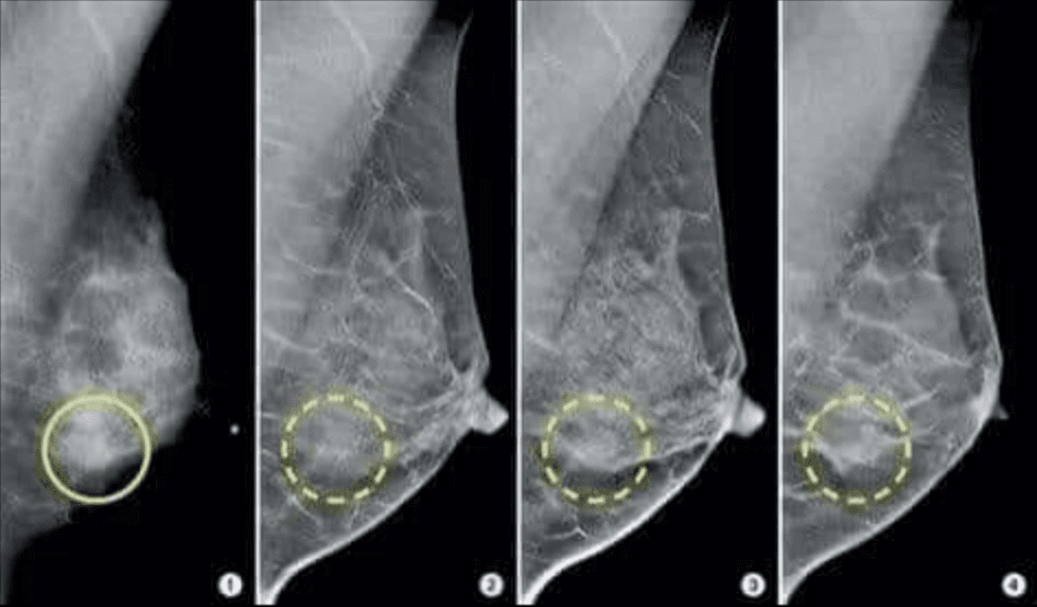 Mammografie zeigt Auffälligkeiten - aber sie sind unbedenklich