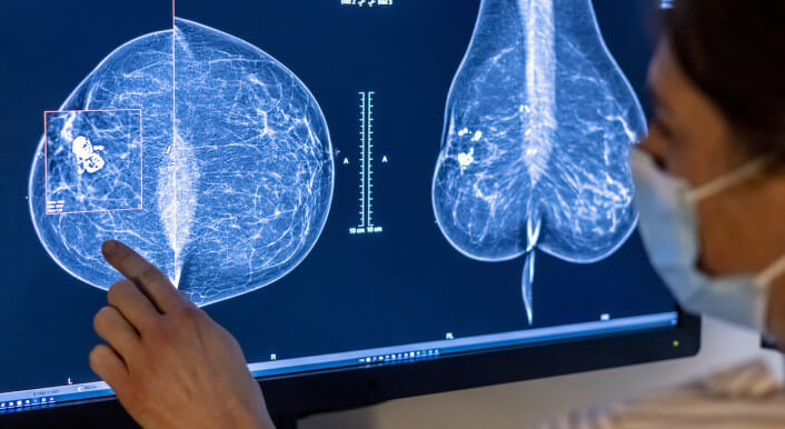 Symbolbild: Medizinisches Personal vor einer Mammographie
