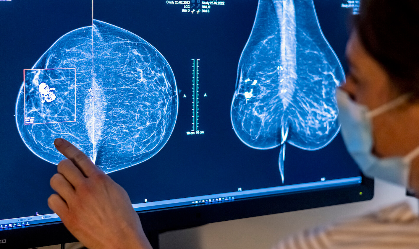 Symbolbild: Medizinisches Personal vor einer Mammographie