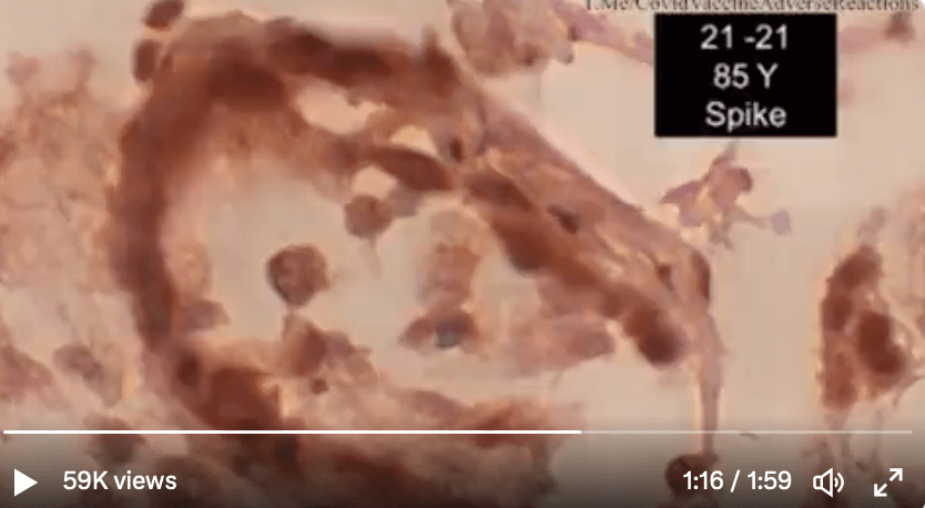 Aufnahme von Gewebeprobe aus Video von Burkhardt