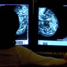 Auswertung einer Mammographie zur Erkennung von Brustkrebs (Foto: Rui Vieira / Picture Alliance / Empics)