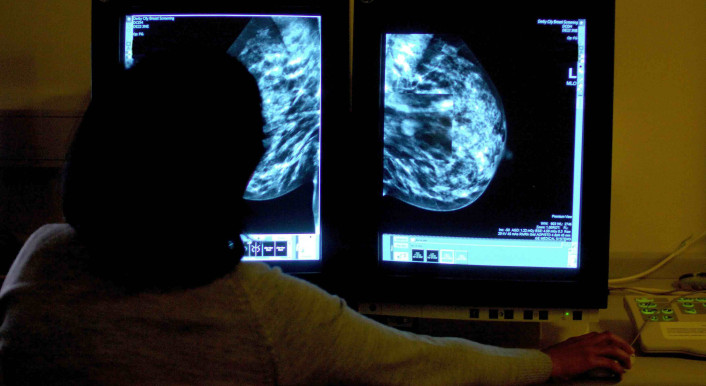 Auswertung einer Mammographie zur Erkennung von Brustkrebs (Foto: Rui Vieira / Picture Alliance / Empics)
