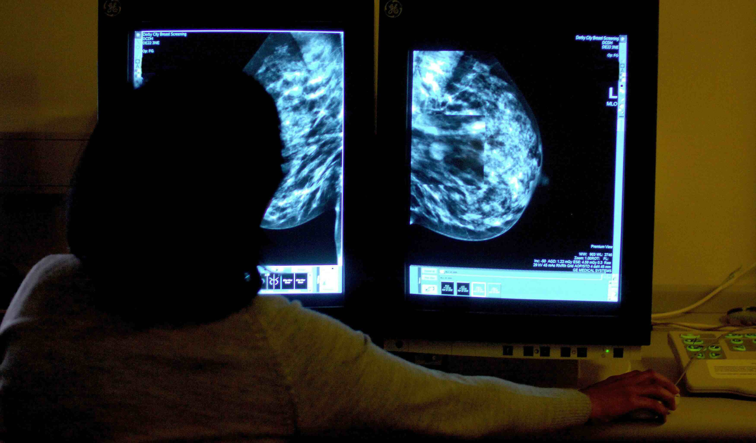 Auswertung einer Mammographie zur Erkennung von Brustkrebs (Foto: Rui Vieira / Picture Alliance / Empics)